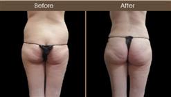 Gluteal Fat Transfer Before & After